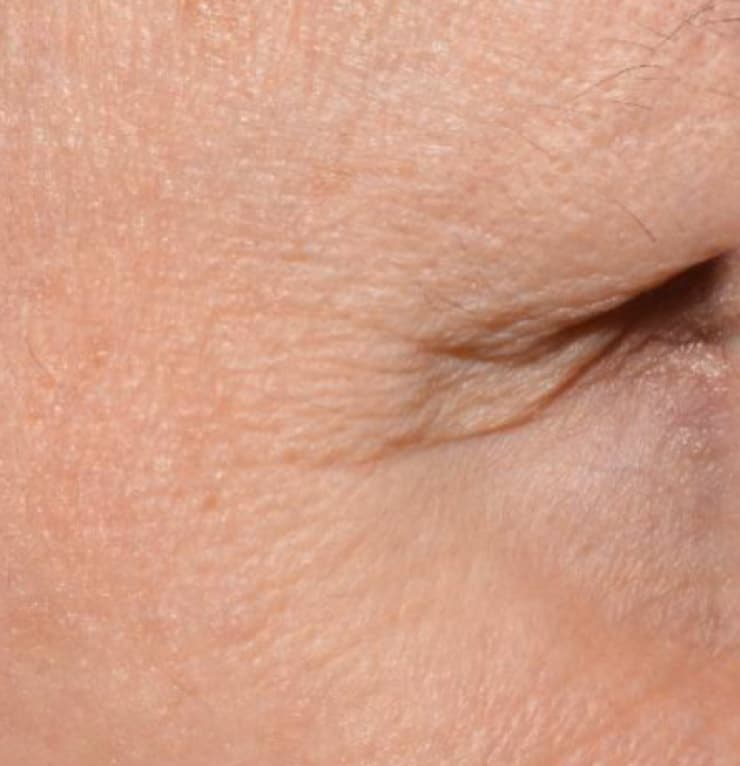 Augenpartie vor Skinhydral⁺